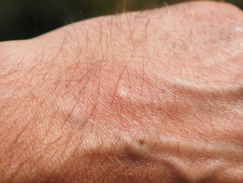 Insektenstich auf einer Hand