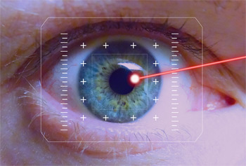 Laserstrahl auf Auge - Laserchirurgie bei Grauem Star